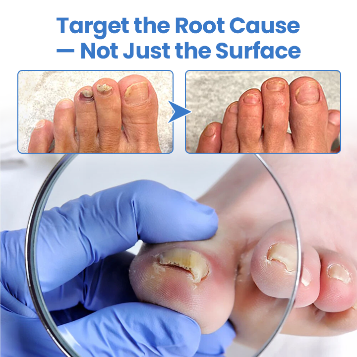 Seurico™ MycoErase Nail Revive Pen — Clear, Healthy Nails in 21 Days