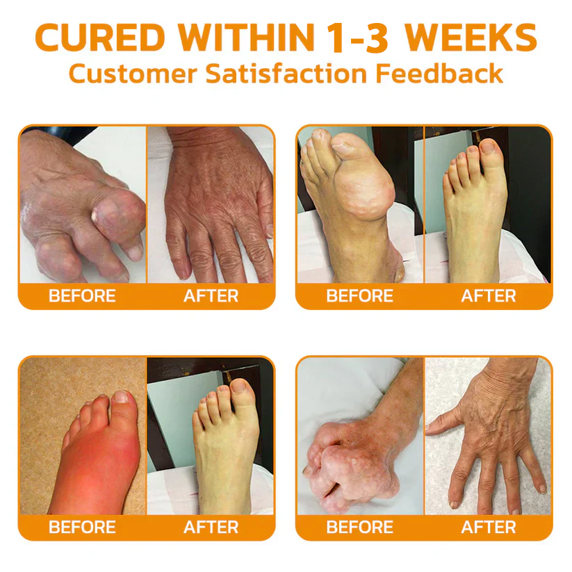 ✅Official Store: Negusy™ Lidocaine Scar-Free Pain Relief Healing Liquid👨‍⚕️USA Osteopathic Medical Association （AAOS）Approved(Reducing joint swelling, pain, stiffness, redness, warmth, soreness and joint fatigue )✨