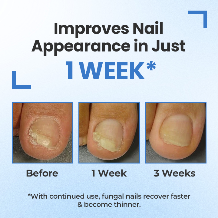 Seurico™ MycoErase Nail Revive Pen — Clear, Healthy Nails in 21 Days