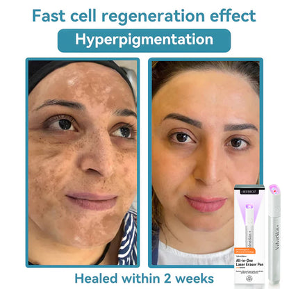 🔥Seurico™ VelvetSkin+ All-in-One Laser Eraser Pen✨ | Safe & Easy At-Home Solution for Smooth, Spot-Free Skin 💆‍♀️🌟