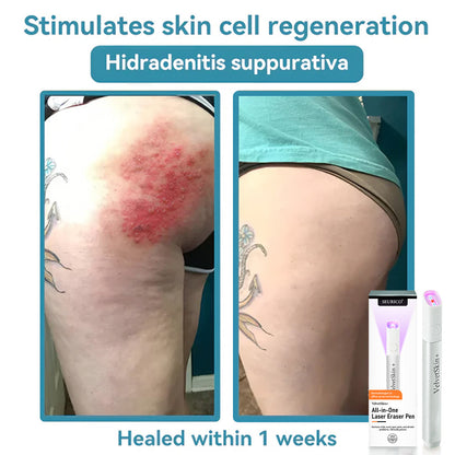 🔥Seurico™ VelvetSkin+ All-in-One Laser Eraser Pen✨ | Safe & Easy At-Home Solution for Smooth, Spot-Free Skin 💆‍♀️🌟