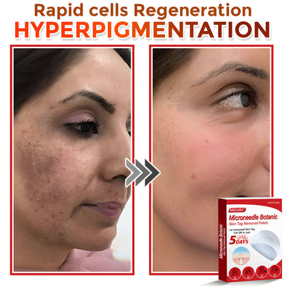 ✅Official Store | Negusy™ MicroNeedle Skin Tag Remover Patch – Made in the USA