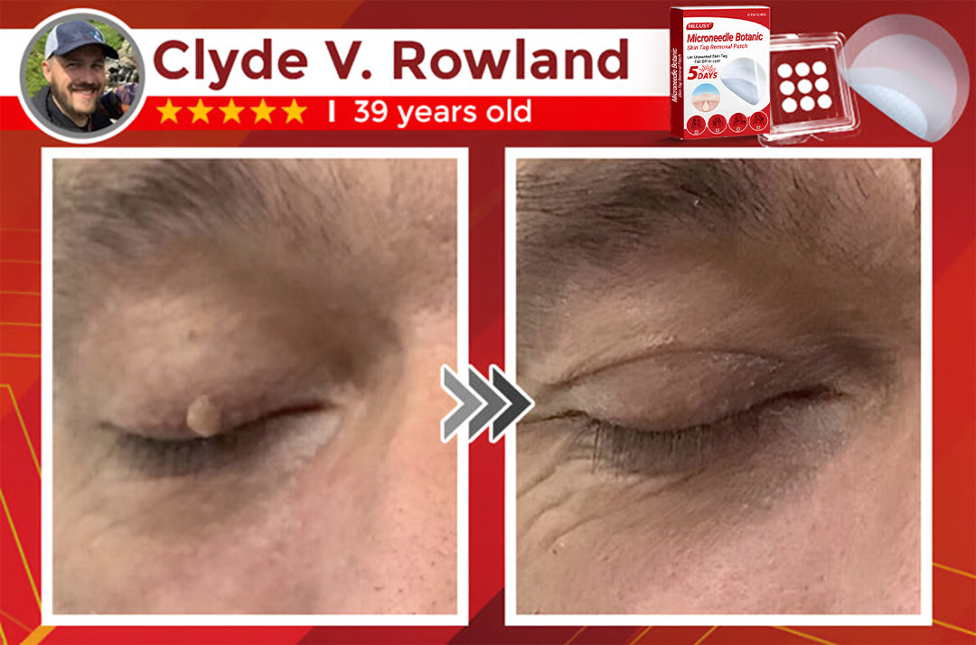 ✅Official Store | Negusy™ MicroNeedle Skin Tag Remover Patch – Made in the USA