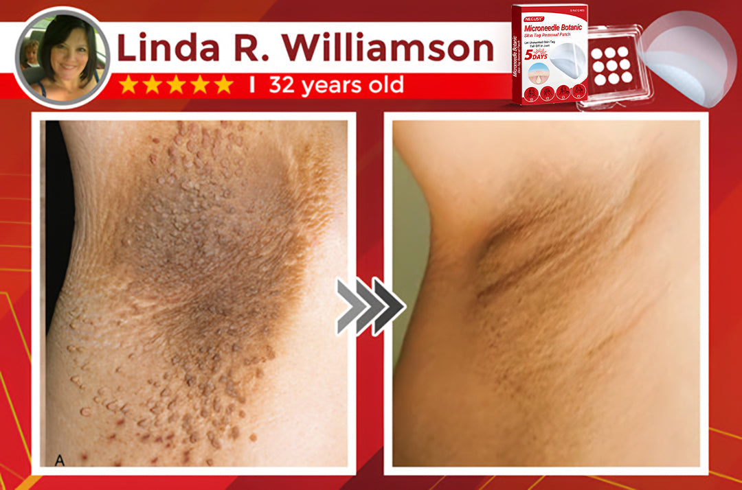 ✅Official Store | Negusy™ MicroNeedle Skin Tag Remover Patch – Made in the USA