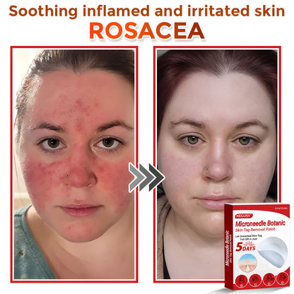 ✅Official Store | Negusy™ MicroNeedle Skin Tag Remover Patch – Made in the USA