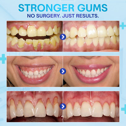 🔥Last Day 69% OFF--🦷 Negusy™ Gum Therapy Agent