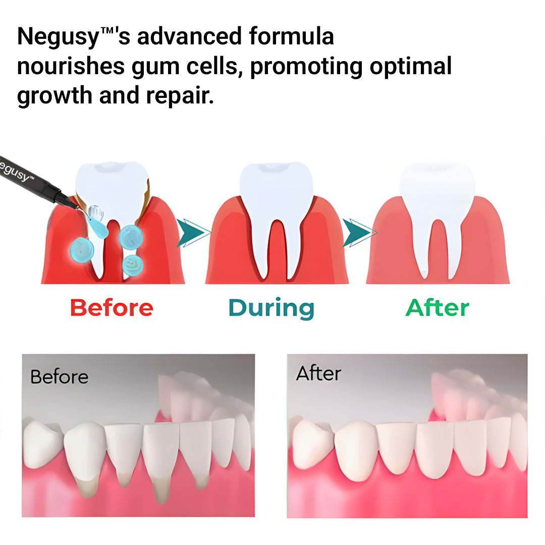 🔥Last Day 75% OFF--🦷 Negusy™ Gum Therapy Agent 🔥