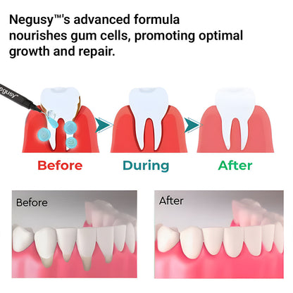🔥Last Day 75% OFF--🦷 Negusy™ Gum Therapy Agent 🔥
