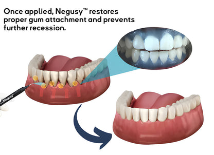 🔥Last Day 75% OFF--🦷 Negusy™ Gum Therapy Agent 🔥
