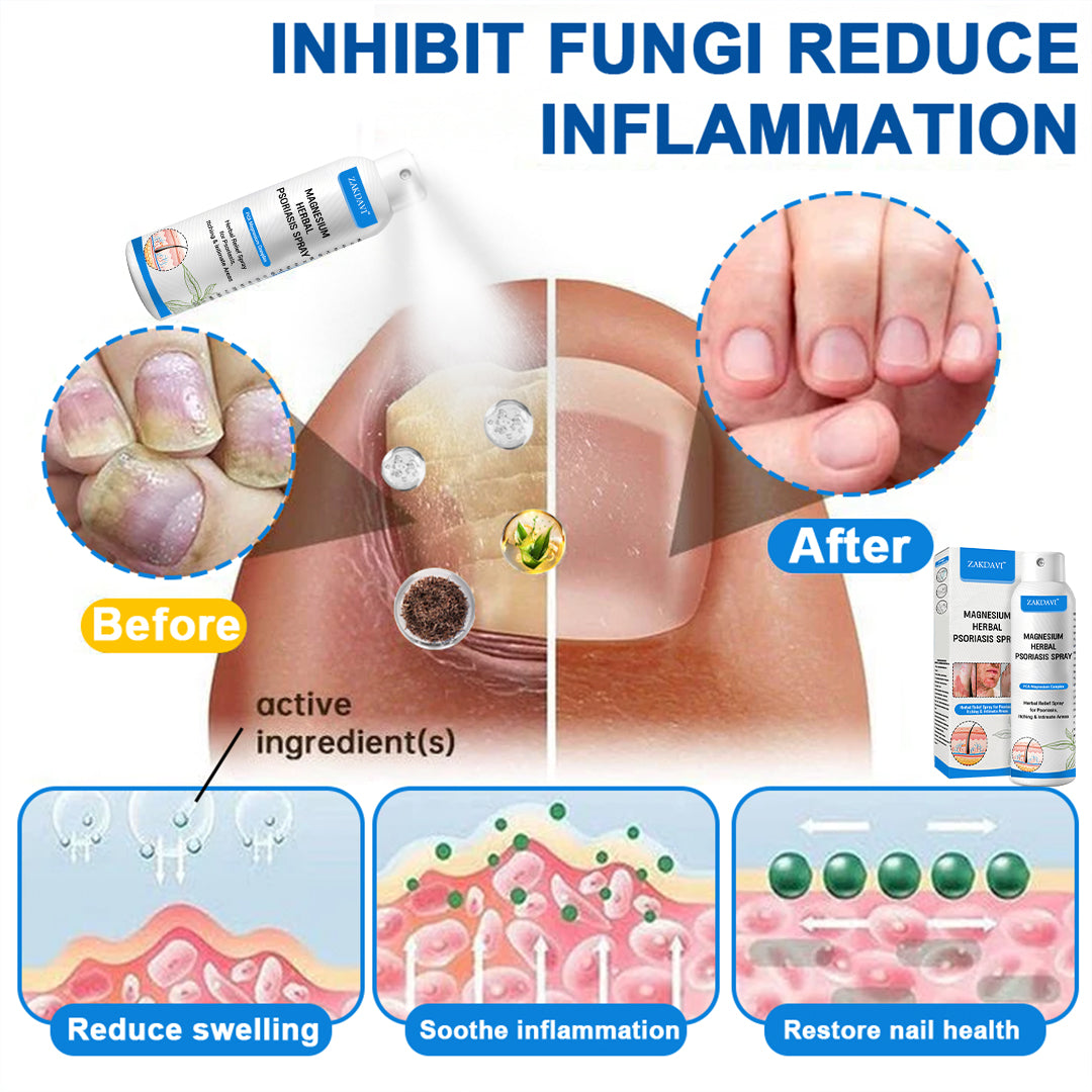 ✅Official Store:  Zakdavi™ Magnesium Herbal Psoriasis Spray – FDA Certified Relief for Psoriasis, Eczema & Skin Tags