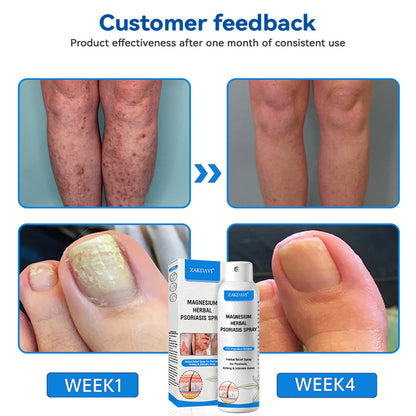 ✅Official Store:  Zakdavi™ Magnesium Herbal Psoriasis Spray – FDA Certified Relief for Psoriasis, Eczema & Skin Tags