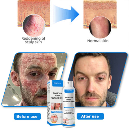 ✅Official Store:  Zakdavi™ Magnesium Herbal Psoriasis Spray – FDA Certified Relief for Psoriasis, Eczema & Skin Tags