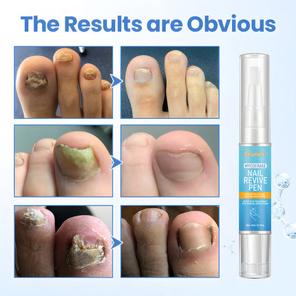 Seurico™ MycoErase Nail Revive Pen — Clear, Healthy Nails in 21 Days